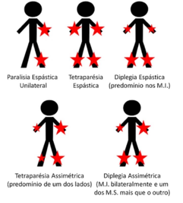 Deficiente Físico: Tipos de deficiência física, nomenclaturas, aquisição de laudo médico e mais 2